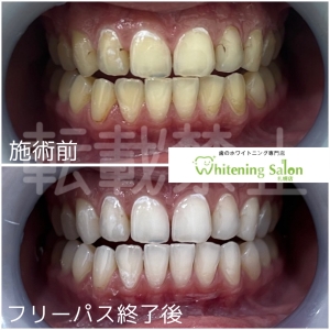 【花粉症で歯が痛くなる？！】