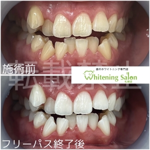 【食いしばりが引き起こす骨隆起】