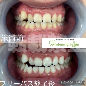 【歯が欠けてしまった時の対処法とは】