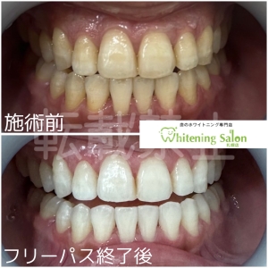 【奥歯、大事にしてますか？】