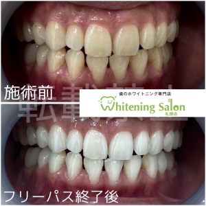 【歯磨きで血が出る！考えられる原因は...】