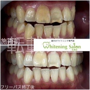 【象牙質】