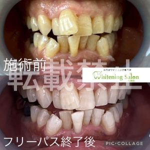 【歯ブラシはどのくらいで交換するのがいいの？】