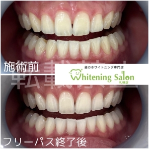 【白い歯を長持ちさせるためには？】