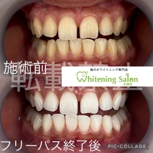 【歯肉退縮とは】