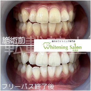 【歯にまつわることわざ】