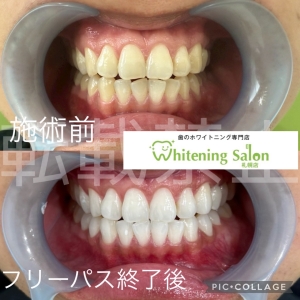 【ながら食べで虫歯になってしまう？】
