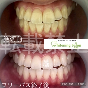 【歯が無くなるランキングとは】