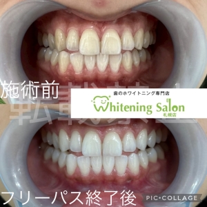 【矮小歯とは？】