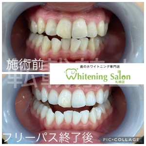 【寒い日に歯が痛くなるのはなぜ？】札幌/ホワイトニング