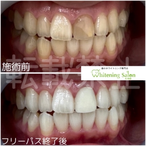 【歯の矯正が終わった後、歯並びが戻る】中央区/ホワイトニング