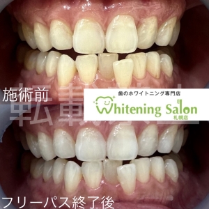 【一度歯周病になると治らない？】札幌/ホワイトニング