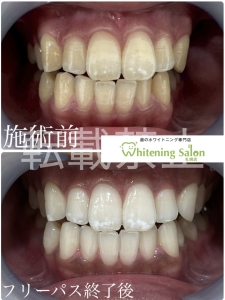 【酸蝕症】すすきの/ホワイトニング