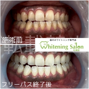 【歯石を自分で取るのは危険？！】札幌/ホワイトニング