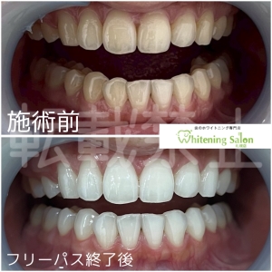 【うがいの回数の目安】札幌中央区/ホワイトニング