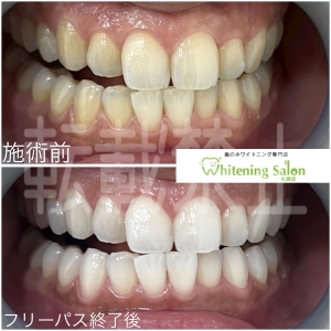 【口の中に存在する菌】札幌大通/ホワイトニング