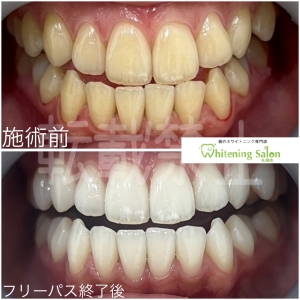 【ブラックトライアングルの原因】北海道/ホワイトニング