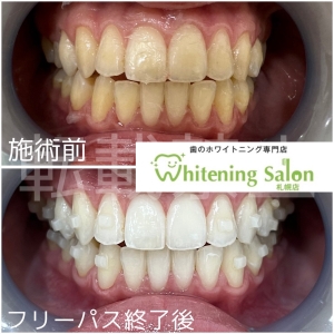 【銀歯から発生するガルバニー電流とは？】札幌/ホワイトニング