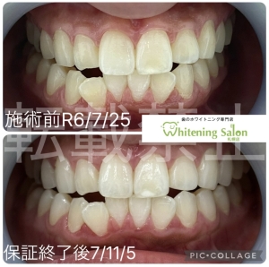 【着色するのはなぜ】すすきの/ホワイトニング