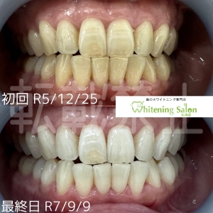 【うがいをするタイミング】札幌大通/ホワイトニング