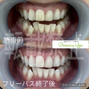 【口の中に存在する菌2】札幌/ホワイトニング