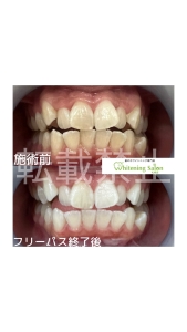 【歯茎から出血】北海道/ホワイトニング