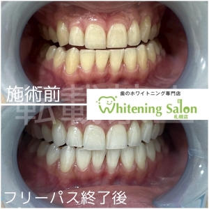 【キシリトールの効果】札幌/ホワイトニング