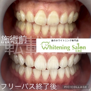 【飲食制限のないホワイトニング】札幌/ホワイトニング