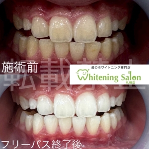 【舌の役割】札幌/ホワイトニング