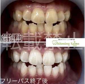 【歯と健康寿命】大通り/ホワイトニング