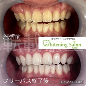 【歯磨き粉とジェル】