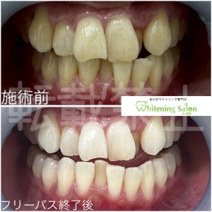 【ブラックトライアングルの予防や治療方法】札幌/ホワイトニング