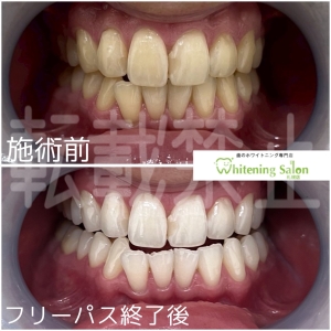 【キシリトールはどれくらい甘い？】札幌大通り駅/ホワイトニング