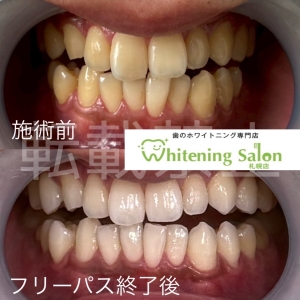 【大人になっても抜けない大人乳歯】札幌/ホワイトニング