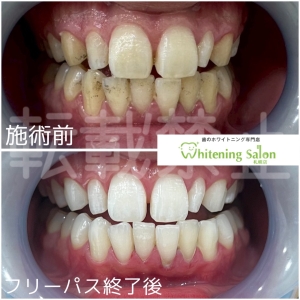 【矯正中のホワイトニング】札幌/ホワイトニング