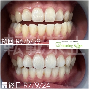 【歯肉炎になってしまったらどうすれば良い？】札幌中央区/ホワイトニング