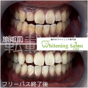 【アルコールが歯にもたらす影響】札幌/ホワイトニング