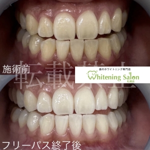 【冬は虫歯のリスクが上がる？】すすきの/ ホワイトニング