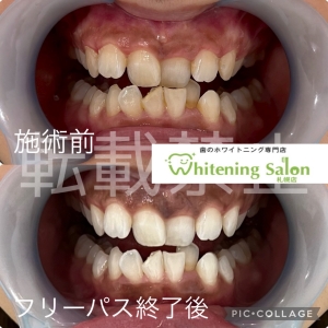 【ながら食べはやめましょう！】札幌/ホワイトニング