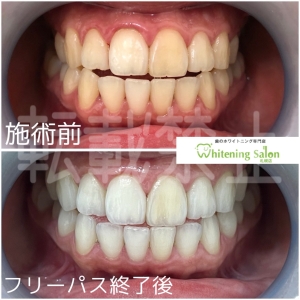 【キシリトールは虫歯予防効果がある！？】大通/ホワイトニング