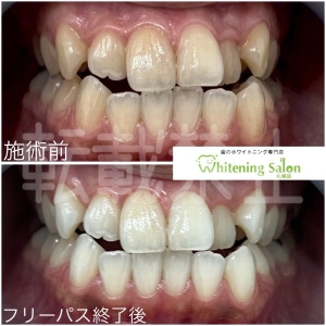 【日本人のホワイトニング意識】大通り/ホワイトニング