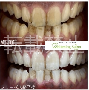 【歯周病って遺伝するの？】札幌/ホワイトニング