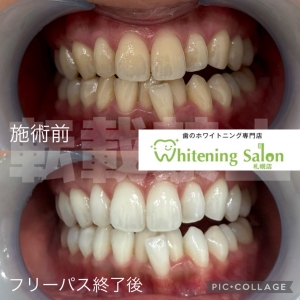 【口の中を噛んでしまう原因】札幌/ホワイトニング