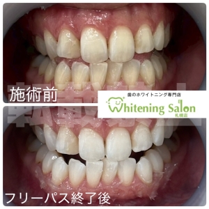 【痛くなくても虫歯？】札幌/ホワイトニング