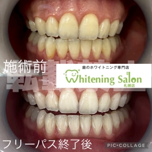 【プロフェッショナルケアとセルフケア】札幌/ホワイトニング