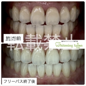 【定期検診は月に1回じゃダメ？】すすきの/ホワイトニング