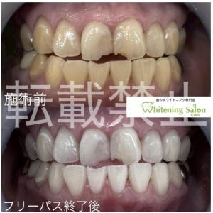 【無糖の炭酸水も歯に悪い？】すすきの/ホワイトニング