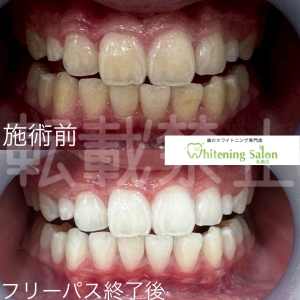 【毎日ホワイトニングしても大丈夫？】大通り/ホワイトニング