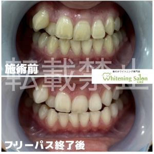 【定期検診が重要な理由】すすきの/ホワイトニング