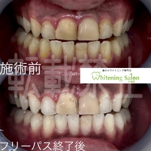 【食いしばりを治す２】大通り/ホワイトニング